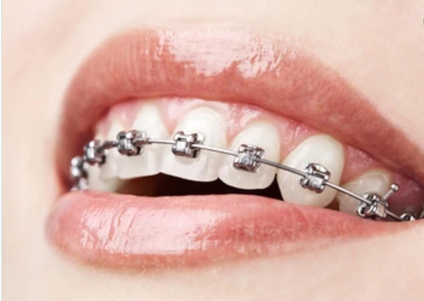 矯正で抜歯が必要な症例とは？