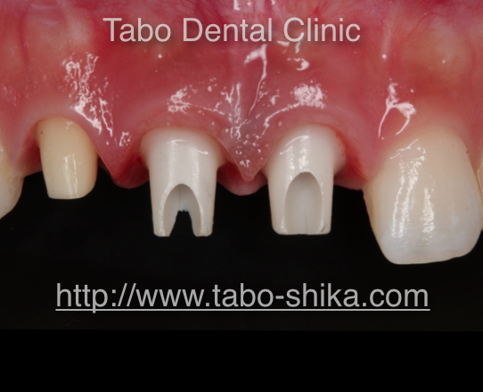 抜歯即時埋入インプラント　保存不可能な歯を抜歯し即日にインプラントを埋入し仮歯まで入れる特殊な方法