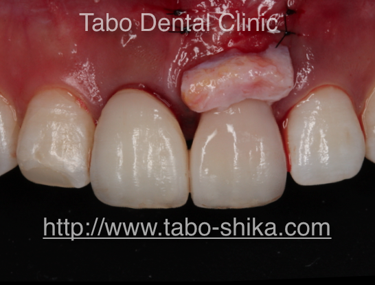 抜歯即時埋入インプラント　保存不可能な歯を抜歯し即日にインプラントを埋入し仮歯まで入れる特殊な方法