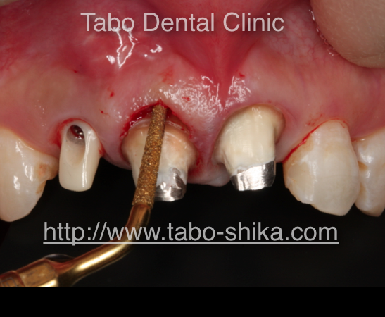 抜歯即時埋入インプラント　歯周形成手術（根尖側移動術）