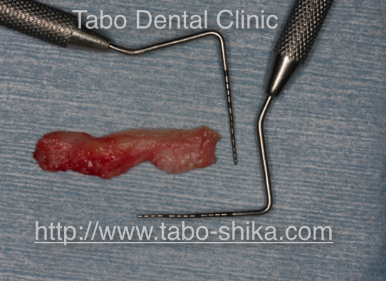 歯周形成外科　根面被覆術（結合組織移植術）