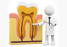 歯の根元から治療する根管治療-重度の虫歯に-