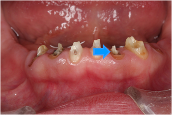 APF　歯肉弁根尖側移動術　歯冠長延長術