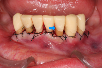 APF　歯肉弁根尖側移動術　歯冠長延長術
