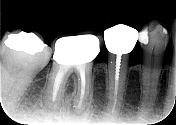 歯根嚢胞の手術の際に根の先から穴を埋めたい