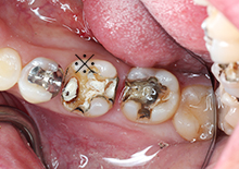 歯が痛む時点で虫歯の症状は進行しています