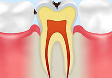 C1【エナメル質の虫歯】