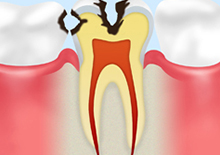 C2【象牙質の虫歯】