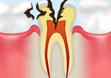 C3【神経まで達した虫歯】