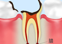 C4【歯根まで達した虫歯】