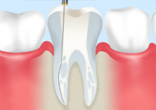 神経まで達した虫歯について～根管治療～