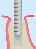 抜歯即時インプラント