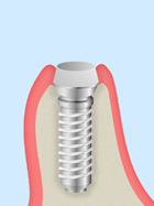 抜歯即時インプラント