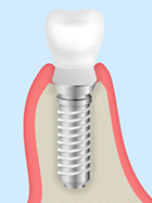 抜歯即時インプラント