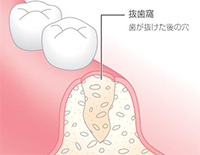 抜歯