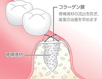 骨補填材の注入と縫合