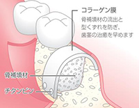 骨補填材の注入と縫合