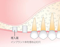 Step01 埋入窩の形成