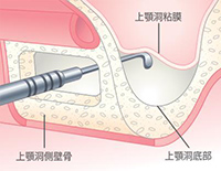 Step01 上顎洞側壁骨の除去と上顎洞粘膜の挙上