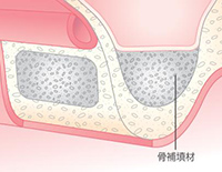 Step02 骨補填材注入