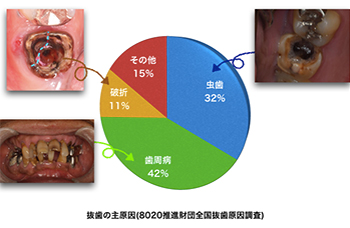 歯を失う原因