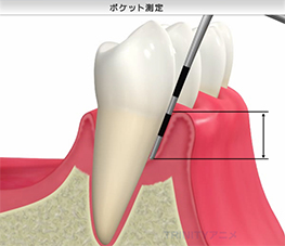 検査③【歯周病検査】
