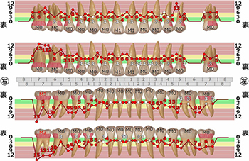 検査③【歯周病検査】