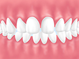 空隙歯列