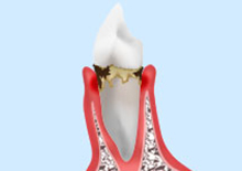 軽度の歯周病