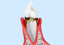 中等度の歯周病