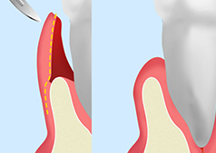歯肉弁根尖側移動術