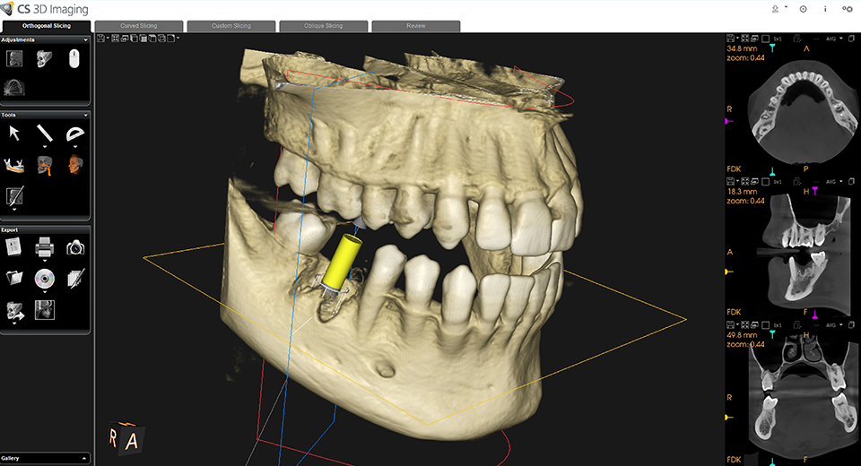 歯科用CTによる3Dデータの取得