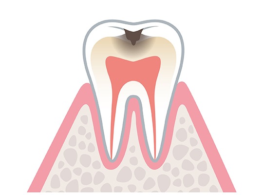 むし歯には急性と慢性があります
