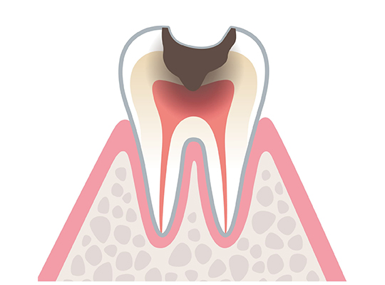 むし歯には急性と慢性があります
